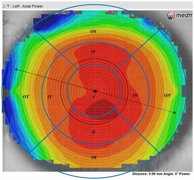The correlation between modifications to corneal topography and changes in retinal vascular density and retinal thickness in myopic children after undergoing <mark class="highlighted">orthokeratology</mark>